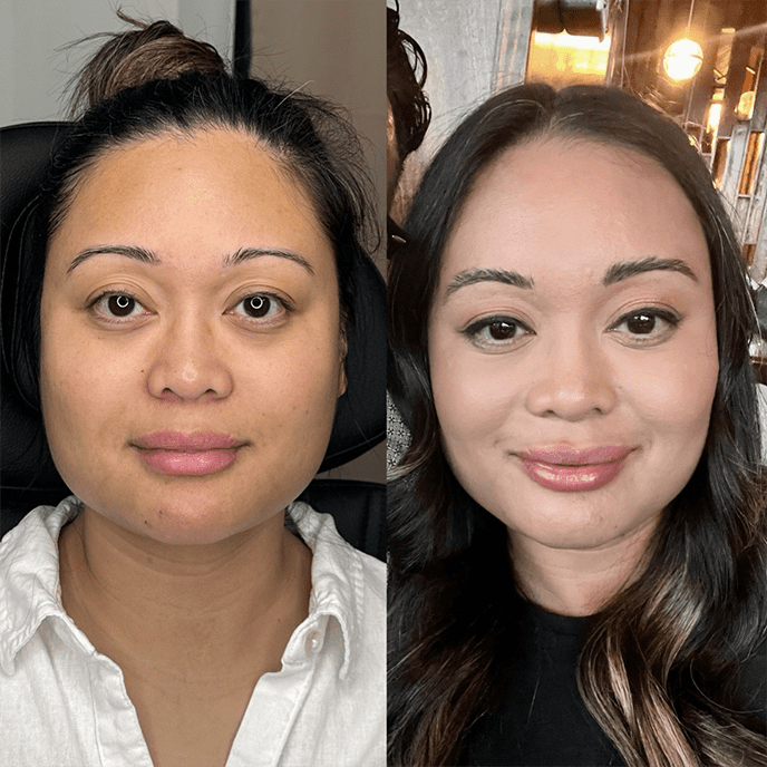 MASSETER BOTOX