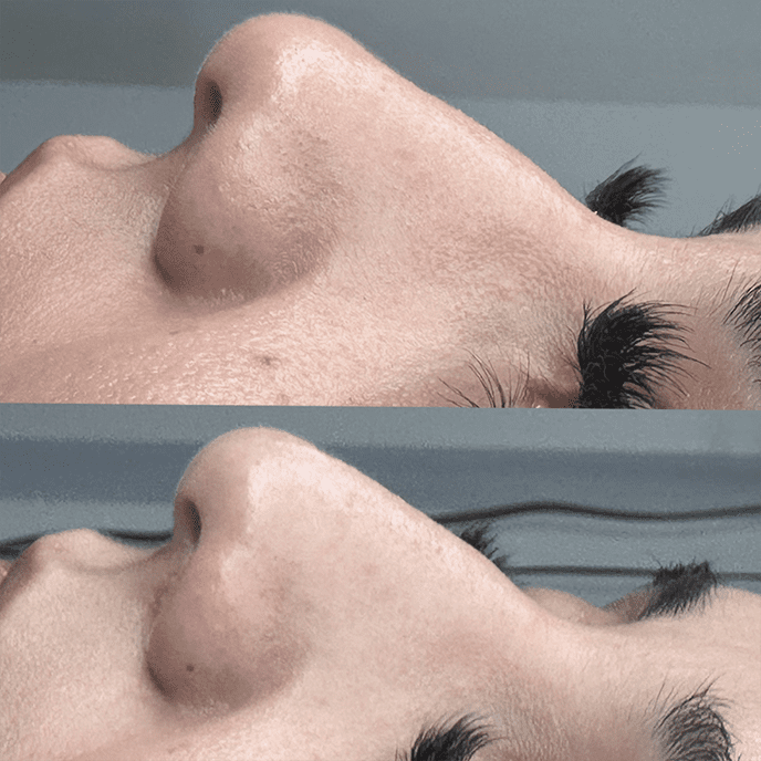 NON SURGICAL NOSE JOB