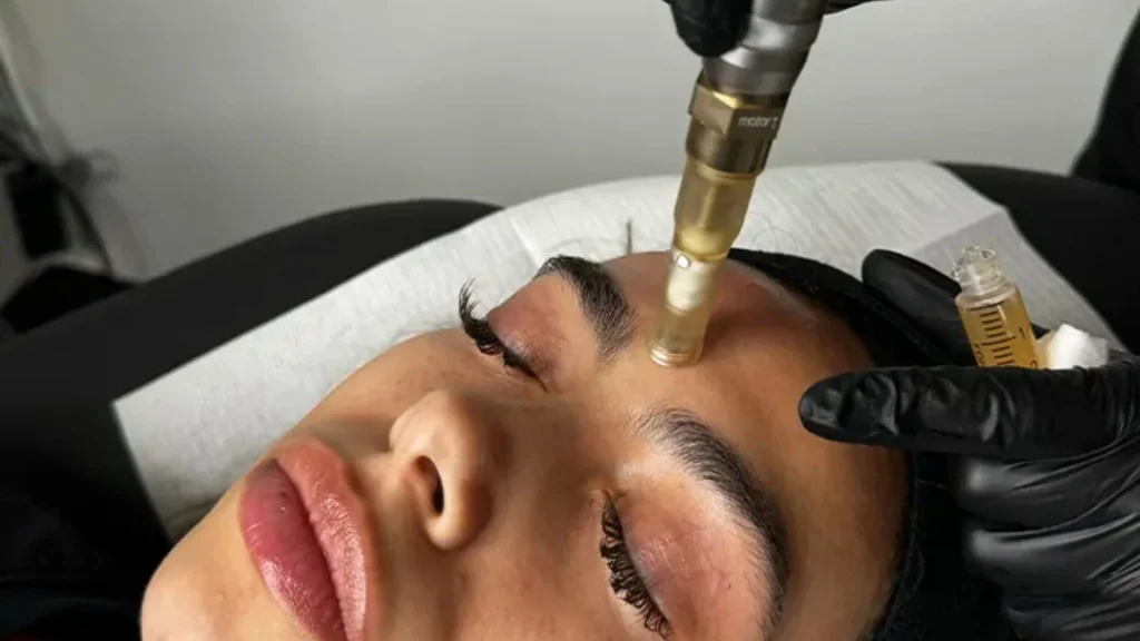 Microneedling treatment
